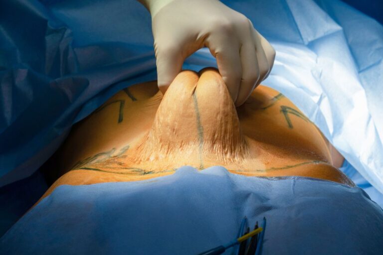Abdominoplastia em Sao Paulo Para Quem e Indicada e Como e a Recuperacao