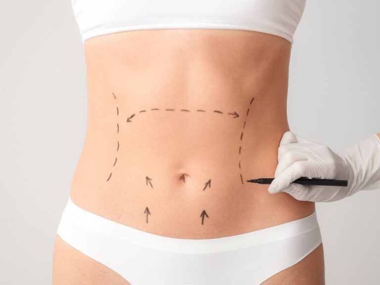 Especialista em abdominoplastia em São Paulo